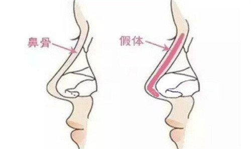 假体前后对比