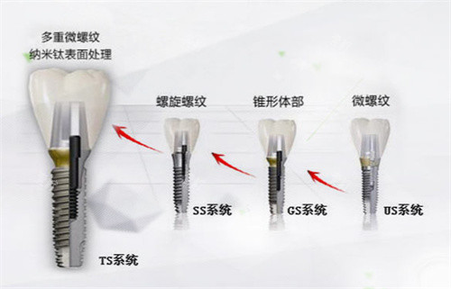 韩国奥齿泰种植体型号