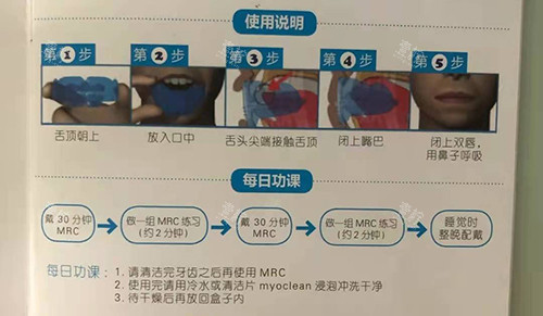 牙齿矫正MRC早期肌功能矫正说明