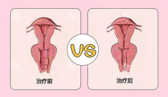 阴道紧缩针前后对比