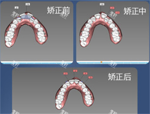 牙齿矫正设计图