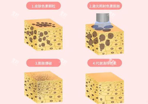 超皮秒皮肤改善原理