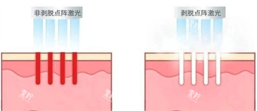 非剥脱和剥脱点阵激光