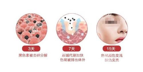 点阵激光的<span style=