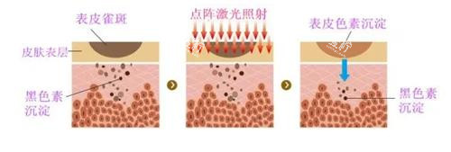 点阵激光的成效