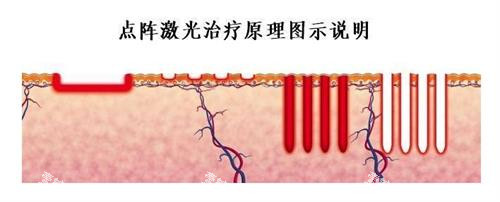 点阵激光的原理