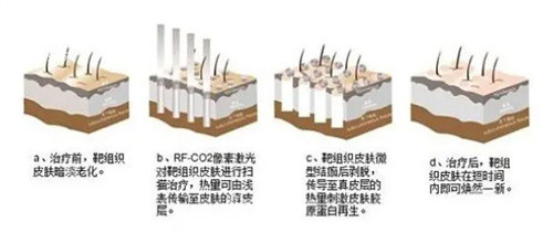 点阵激光治疗原理