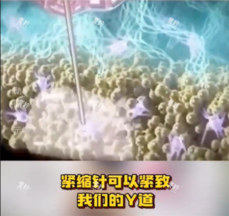 紧缩针怎么样