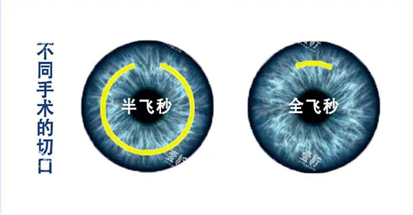 半飞秒和全飞秒区别