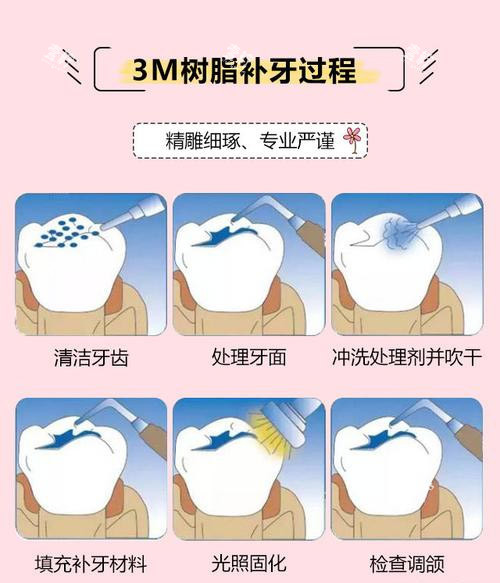 3M树脂补牙方法