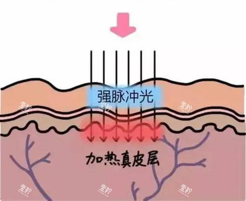 光子嫩肤针对的皮肤层