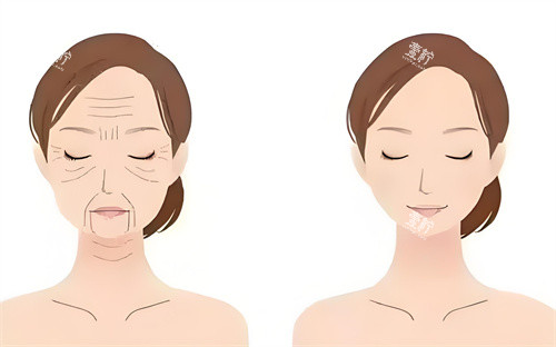 眼袋手术前后对动画图