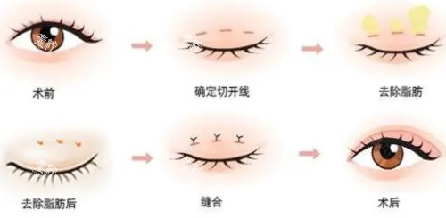 兰州双眼皮费用一般多少钱?像时光/华美都是什么价格?