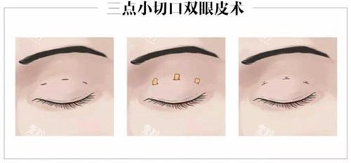 ​兰州好的一点的做双眼皮的地方,主打自然风的有几家?