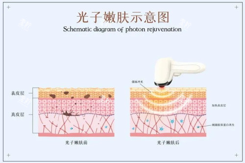光子嫩肤的示意图