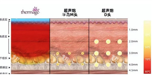超声炮治疗深度对比