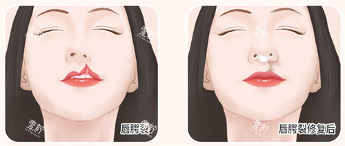 唇腭裂修复