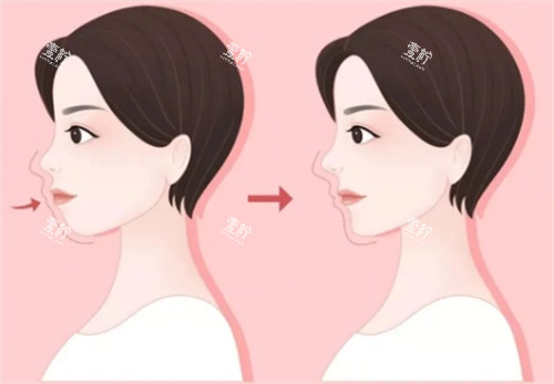 深圳口腔正颌哪家可靠?正规手术还做的好的有谁?
