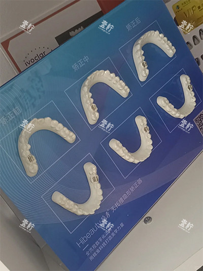 隐秀隐形牙齿矫正