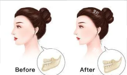 正颌手术后的成效图片
