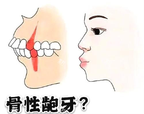 成人龅牙矫正牙齿神器靠谱能用吗?哪个性价比更高?
