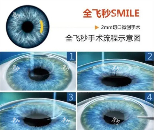 全飞秒激光手术全过程步骤,从术前准备到术后每一步都关键