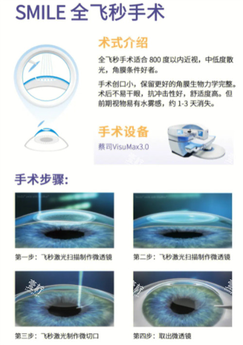 全飞秒近视手术术式介绍图解