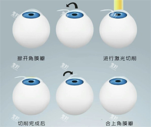 半飞秒手术过程