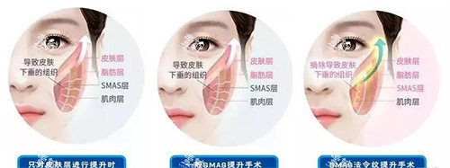 北京穆宝安V美减龄提升术大揭秘!成效/维持时间/价格一网打尽