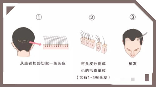 头发移植图示