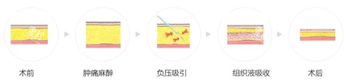 吸脂过程图解