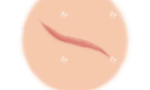 疤痕增生的不同动画展示图