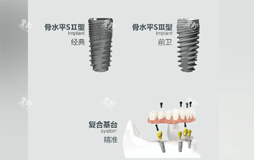 安联种植牙用起来怎么样