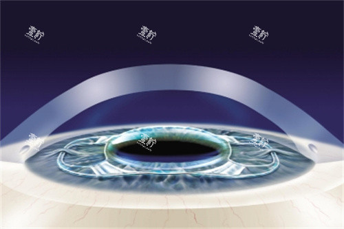 ICL晶体4 ICL晶体4