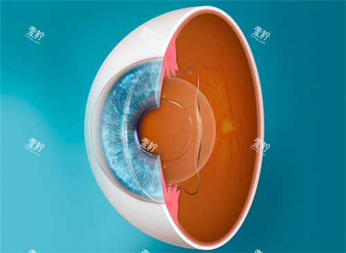 ICL晶体植入图 ICL晶体植入图