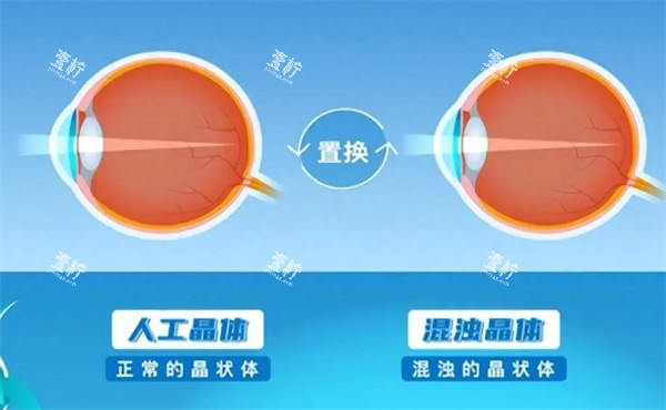 人工晶体置换示意图