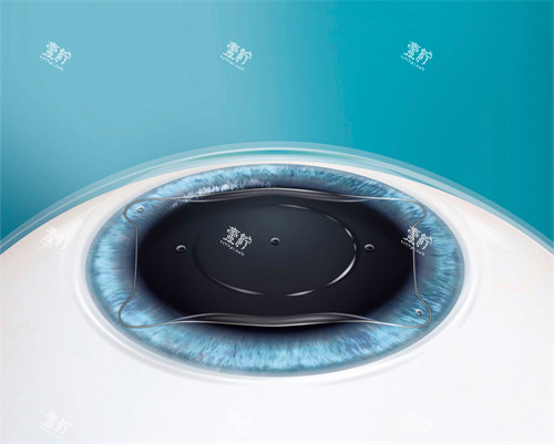 人工晶体植入眼睛后图示