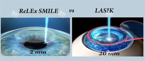 全飞秒近视手术带来的切口图解 全飞秒近视手术带来的切口图解