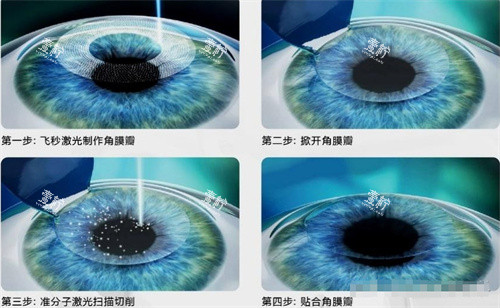 飞秒激光手术示意图 飞秒激光手术示意图