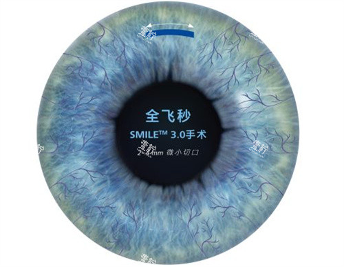 半飞秒手术卡通图 半飞秒手术卡通图