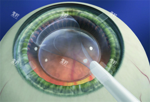晶体植入手术图 晶体植入手术图