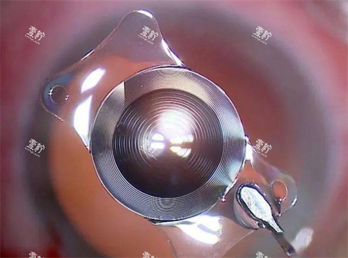 白内障晶体展示 白内障晶体展示