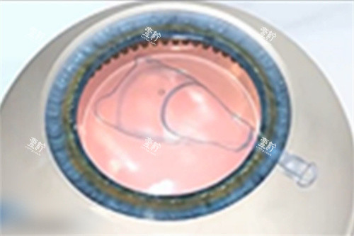 展开ICL晶体 展开ICL晶体