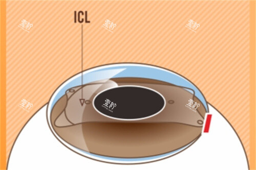 ICL晶体植入后示意图 ICL晶体植入后示意图