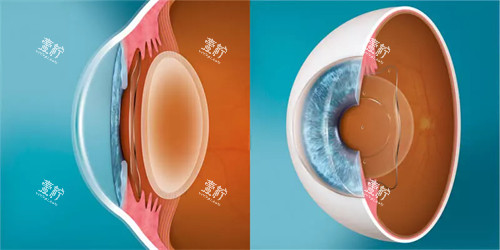 ICL晶体植入前后对比 ICL晶体植入前后对比