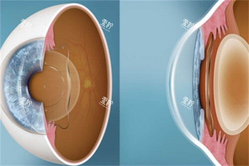 ICL晶体切面图 ICL晶体切面图