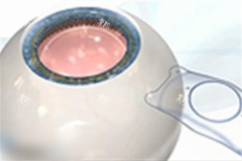 准备放入ICL晶体 准备放入ICL晶体