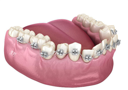 金属牙齿矫正展示图 金属牙齿矫正展示图