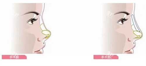 隆鼻手术前后对比