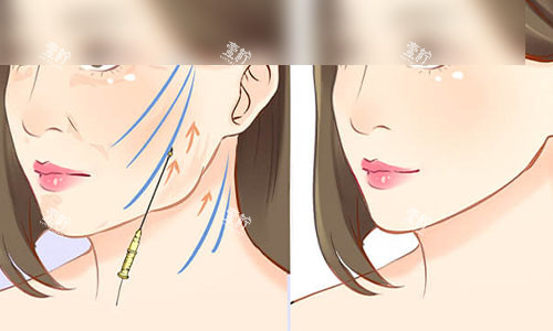 拉皮手术成效示意图